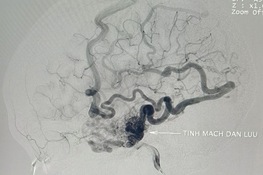 Cô gái trẻ thường xuyên động kinh vì bệnh lý nguy hiểm