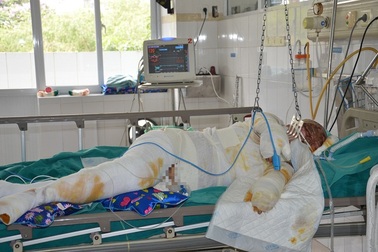 Xót xa người vợ trẻ đi hái mít bị điện cao thế giật nguy kịch đến tính mạng