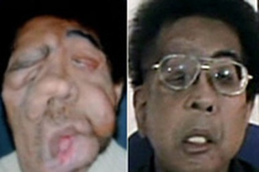 Những ca phẫu thuật khó tin nhất trong lịch sử