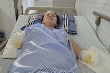 Bỏng điện cao thế, người phụ nữ nghèo mất đôi tay, khó giữ được chân trái