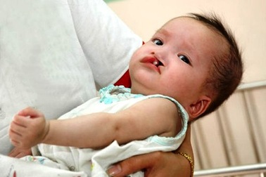 Phẫu thuật miễn phí cho trẻ bị khuyết tật môi, hàm ếch 