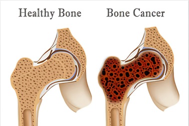 Các phương pháp điều trị ung thư xương