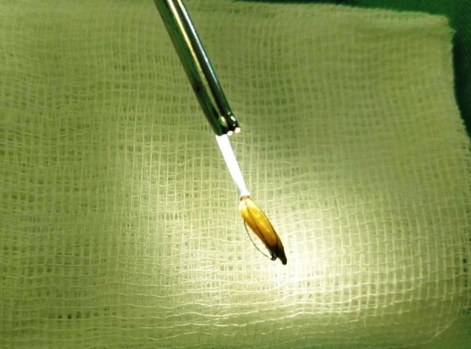 Hy hữu, người đàn ông nhập viện vì bị hạt thóc mắc kẹt trong dương vật - 1