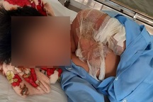 Bé trai 11 tuổi nghi bị cha ruột tạt nước sôi gây bỏng nặng