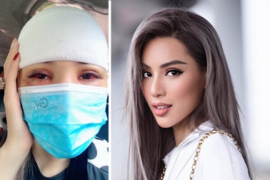 Siêu mẫu Khả Trang bị tai nạn hy hữu phải khâu 10 mũi