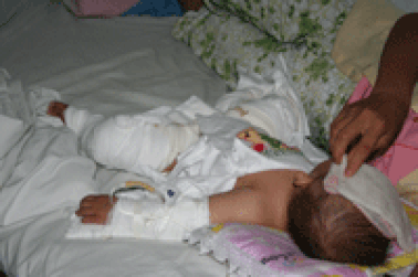 Điều trị bỏng: 95,4% cơ sở y tế thiếu trang thiết bị cơ bản