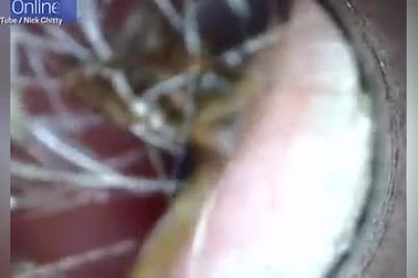 Clip gắp nhện chết ra khỏi ống tai bệnh nhi khiến nhiều người rùng mình