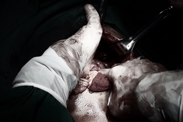 Chủ quan sau tai nạn, nam thanh niên suýt mất mạng