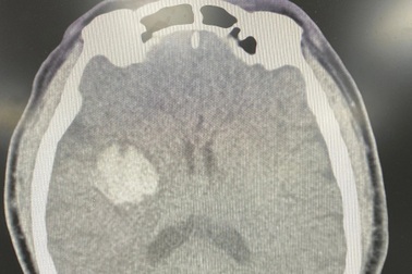 Uống An cung ngưu hoàng hoàn, nam bệnh nhân nhập viện cấp cứu