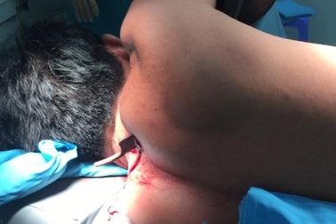 Cần Thơ: Cứu sống bệnh nhân bị đâm thủng phổi, kéo còn dính chặt ở lưng