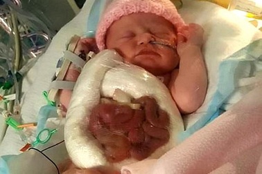 Bé sơ sinh quấn màng bọc thực phẩm vì "ruột để ngoài da"
