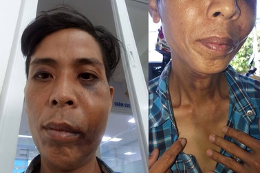 Dân tố bị Trưởng công an xã đánh phải nhập viện