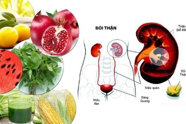 Biện pháp đơn giản hàng đầu giúp đẩy lùi sỏi thận