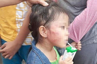 TPHCM: Bàng hoàng cô giáo mầm non tát thâm mặt bé gái 5 tuổi