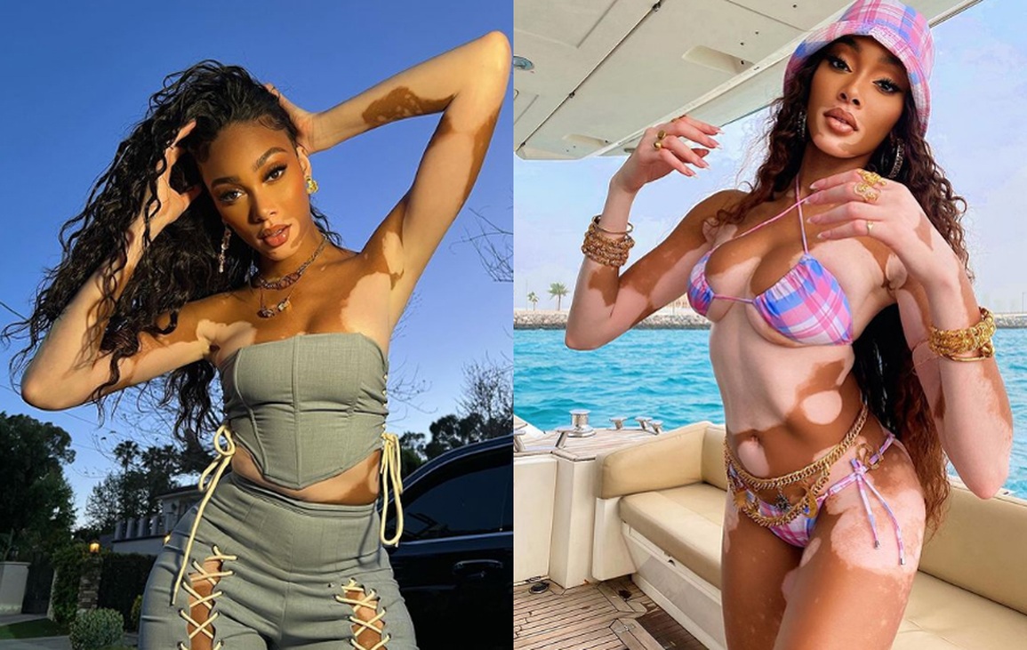 Siêu mẫu bạch biến Winnie Harlow từng bị bạn bè xa lánh - 2 Siêu mẫu bạch biến Winnie Harlow từng bị bạn bè xa lánh - 2