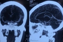 Nguyên nhân khiến cô gái 29 tuổi đã bị đột quỵ