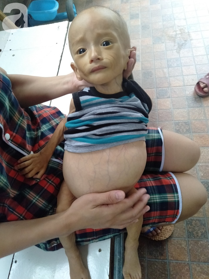 Sự sống mong manh của bé trai 1 tuổi, chỉ nặng 6kg, bụng phình to như cái trống mà mẹ nghèo không tiền chữa trị - Ảnh 10. Sự sống mong manh của bé trai 1 tuổi, chỉ nặng 6kg, bụng phình to như cái trống mà mẹ nghèo không tiền chữa trị - Ảnh 10.