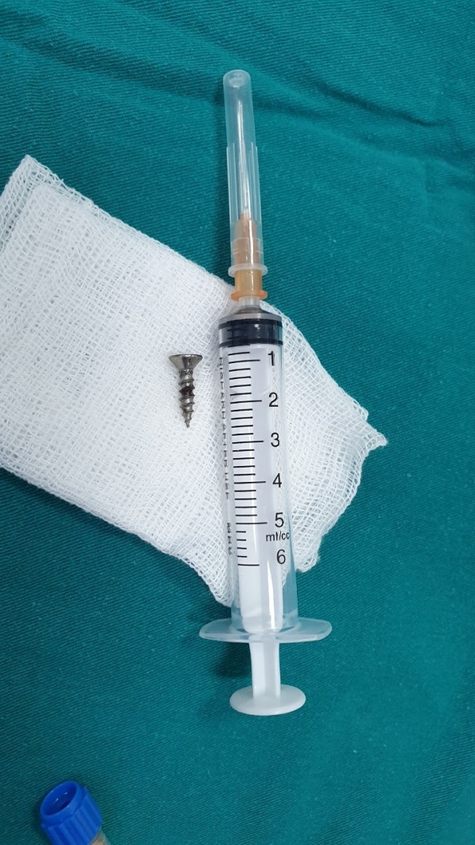 Bác sĩ đã gắp chiếc đinh ốc vít sắc nhọn mà không gây thương tổn gì cho đường thở của cháu bé.