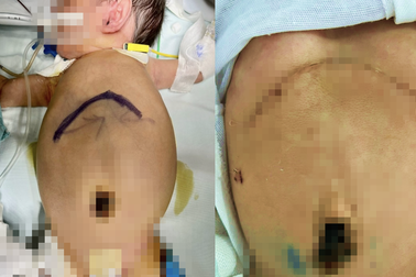 Bé vừa sinh bụng đã phình to vì khối u "hiểm" thế giới chỉ ghi nhận vài ca