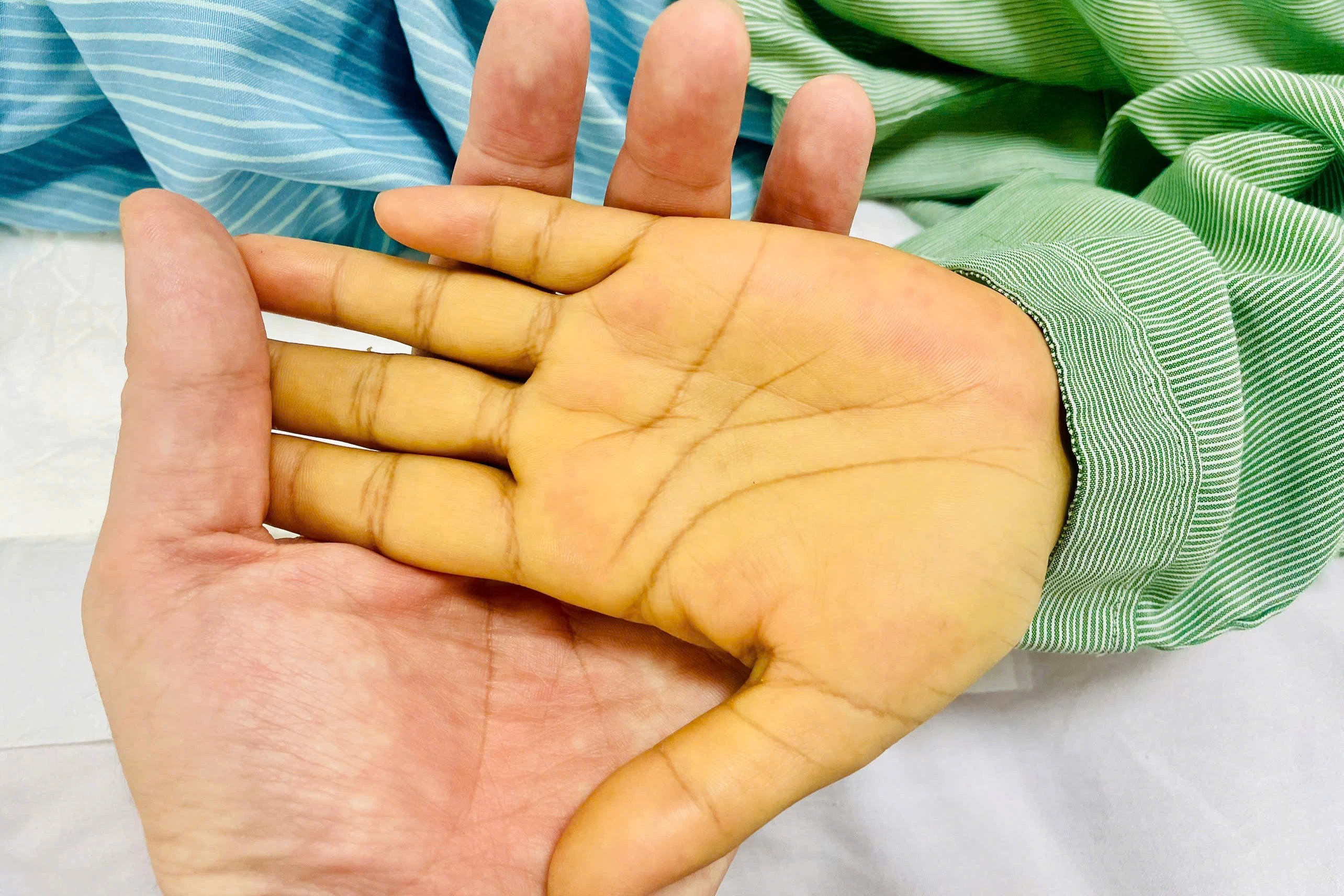 Người phụ nữ da vàng như nghệ, suýt chết vì căn bệnh thường gặp - 1