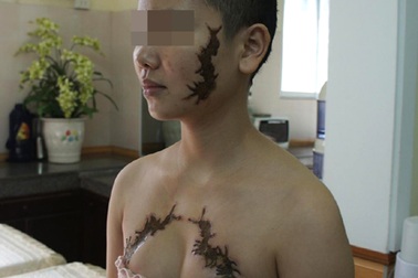 Bài 2: Cô gái bị xăm "quái vật" lên mặt và ngực được nhận chữa miễn phí