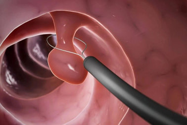 Polyp đại tràng có đáng ngại?