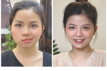 Bệnh nhân liệt mặt 3 tháng phục hồi nhờ y học cổ truyền