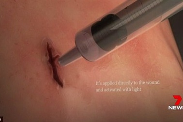 Đột phá ‘keo dán’ làm liền vết thương hở trong 60 giây