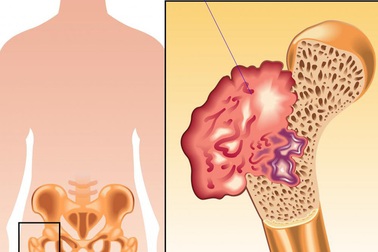 Nguyên nhân gây bệnh ung thư xương