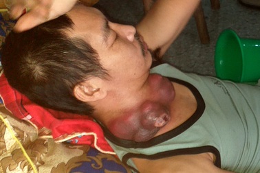 Người đàn ông nghèo đau đớn mang khối u như những chiếc bát úp vào cổ