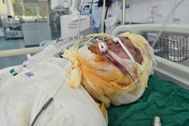 Bác sĩ kêu gọi cứu chàng trai dân tộc Mông nguy kịch vì bỏng điện