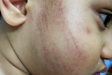 Tát trẻ 18 tháng bầm mặt, cô giáo mầm non bị buộc thôi việc