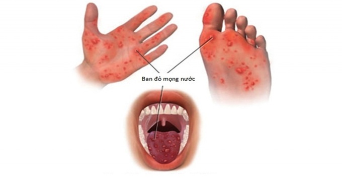 Hình ảnh minh họa bệnh tay chân miệng ở trẻ em.