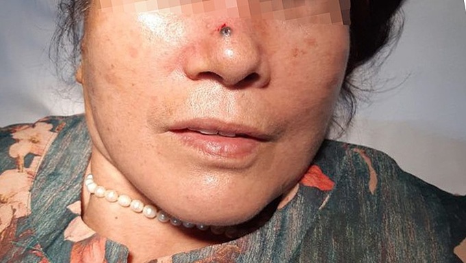 Tưởng nốt ruồi hóa ung thư - Ảnh 1. Tưởng nốt ruồi hóa ung thư - Ảnh 1.