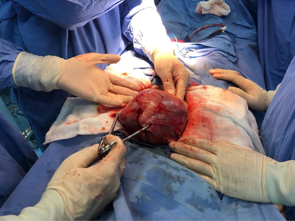 Quảng Nam: Khối u xơ nặng bằng em bé sơ sinh trong bụng người phụ nữ  - 1