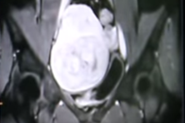 Làm xẹp khối u xơ tử cung lành tính bằng sóng siêu âm