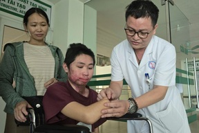 Nam sinh bỏng điện mất tay và 2 chân được hỗ trợ lắp chân giả