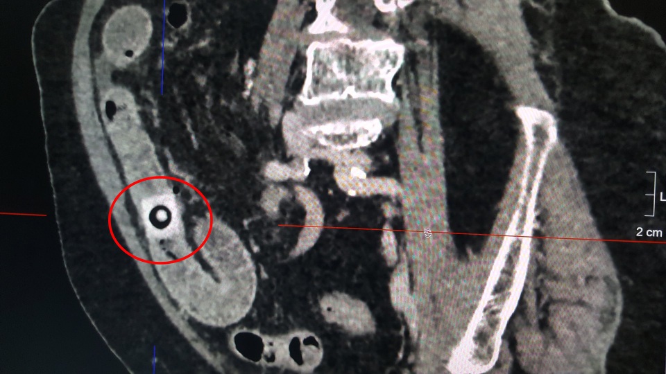 Cảnh báo tai nạn uống thuốc còn nguyên vỉ ở người già - 1 Cảnh báo tai nạn uống thuốc còn nguyên vỉ ở người già - 1