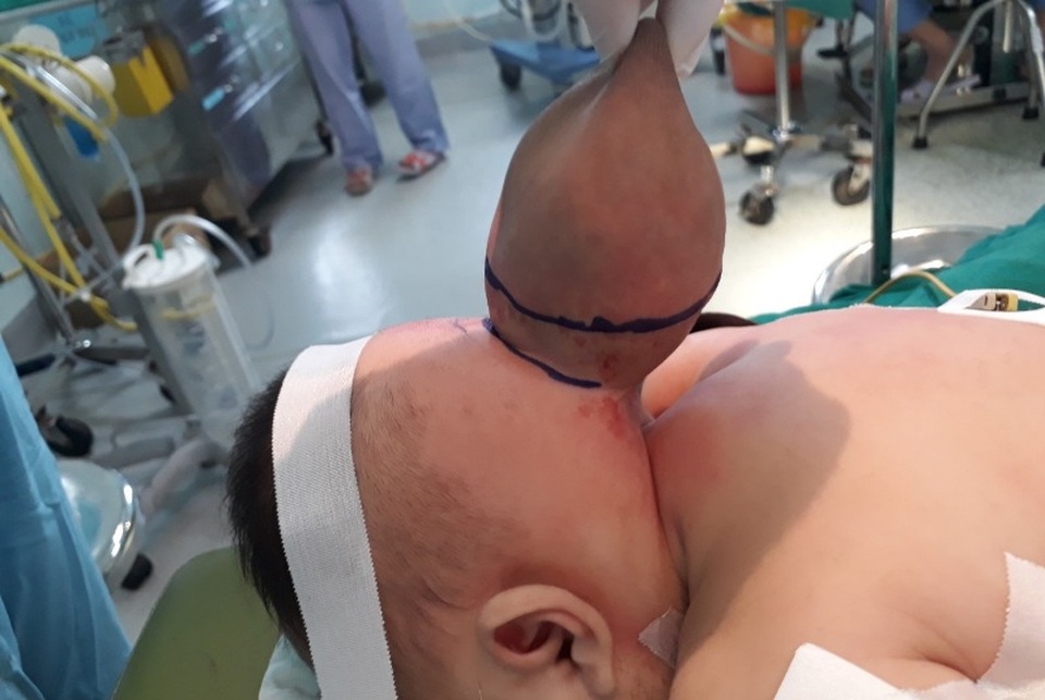 Hoảng hồn khối thoát vị não - màng não to như quả dừa ở bé gái 3 tháng tuổi - 1 Hoảng hồn khối thoát vị não - màng não to như quả dừa ở bé gái 3 tháng tuổi - 1