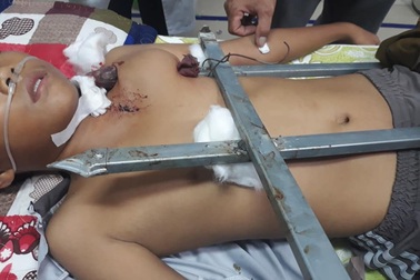 Cứu sống cháu bé bị thanh sắt đâm thấu ngực