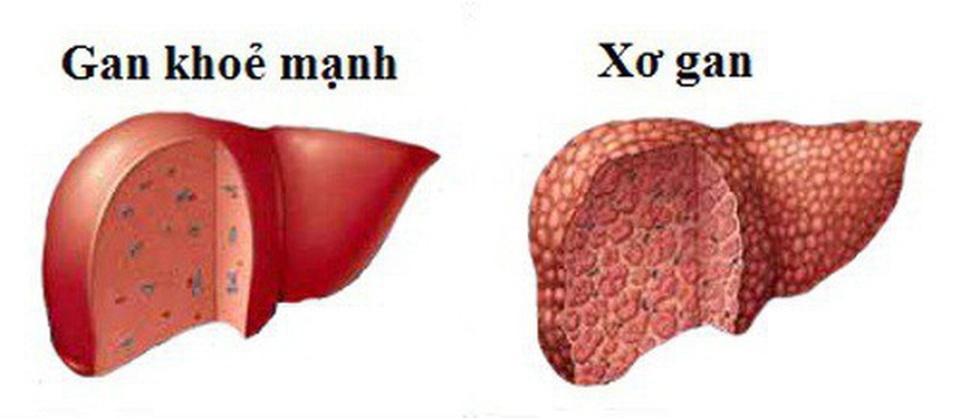 Điểm mặt 5 nguyên nhân gây xơ gan hàng đầu ở nước ta - 1 Điểm mặt 5 nguyên nhân gây xơ gan hàng đầu ở nước ta - 1