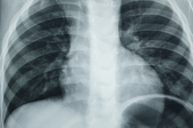 Cậu bé 2 tuổi bị dị vật mảnh kim loại “ăn” vào thực quản, ho cả tháng mới được phát hiện