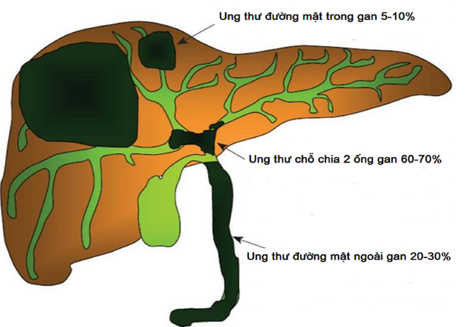 Ung thư đường mật: Chẩn đoán vô cùng khó khăn - 1 Ung thư đường mật: Chẩn đoán vô cùng khó khăn - 1