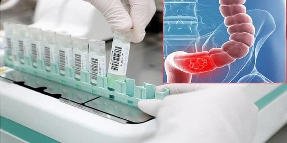 Có yếu tố này, bạn nên bắt đầu tầm soát ung thư đại trực tràng - 2 Có yếu tố này, bạn nên bắt đầu tầm soát ung thư đại trực tràng - 2