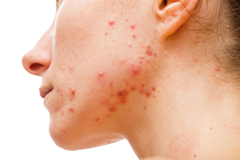 Bác sĩ da liễu mách bạn cách thoát khỏi mụn trứng cá - 1 Bác sĩ da liễu mách bạn cách thoát khỏi mụn trứng cá - 1