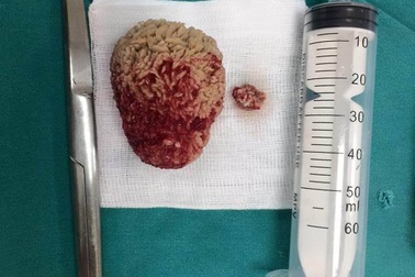 Khối sỏi to như quả trứng vịt sau 20 năm chữa thận bằng thuốc nam