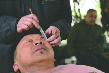 Rùng mình với thú "cạo mắt” ở Trung Quốc