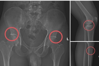 Tự đục vỡ xương để “qua mặt” bảo hiểm