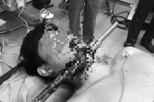 Nam thanh niên bị thanh sắt đâm xuyên vùng cổ, nghi do ẩu đả