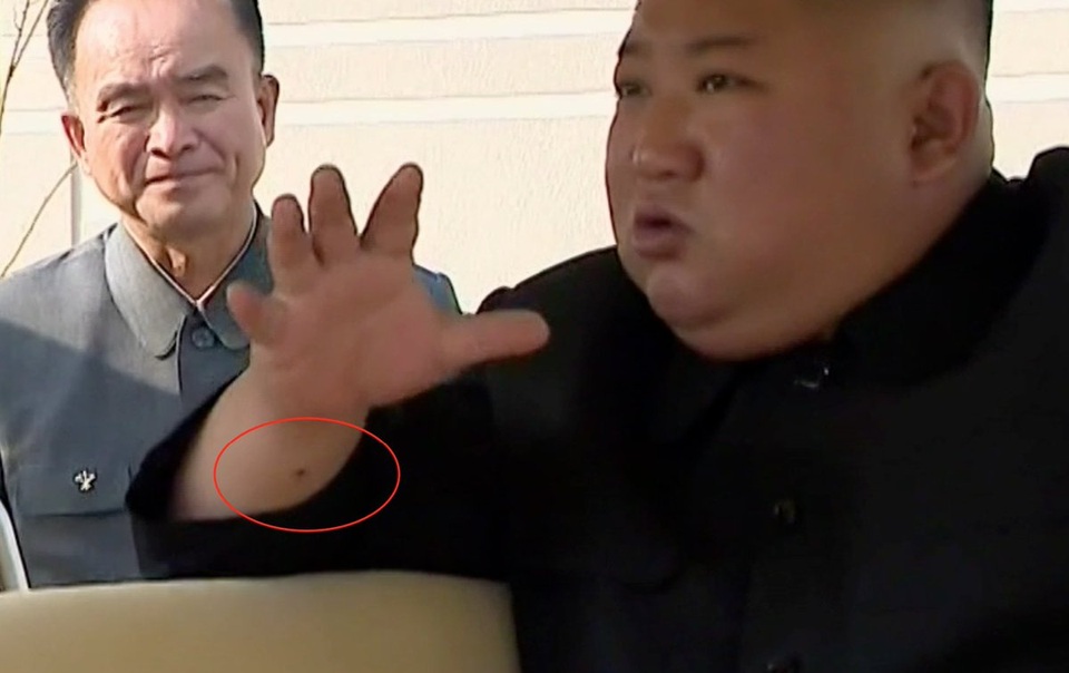 Vết đỏ bí ẩn trên cổ tay ông Kim Jong-un - 1 Vết đỏ bí ẩn trên cổ tay ông Kim Jong-un - 1